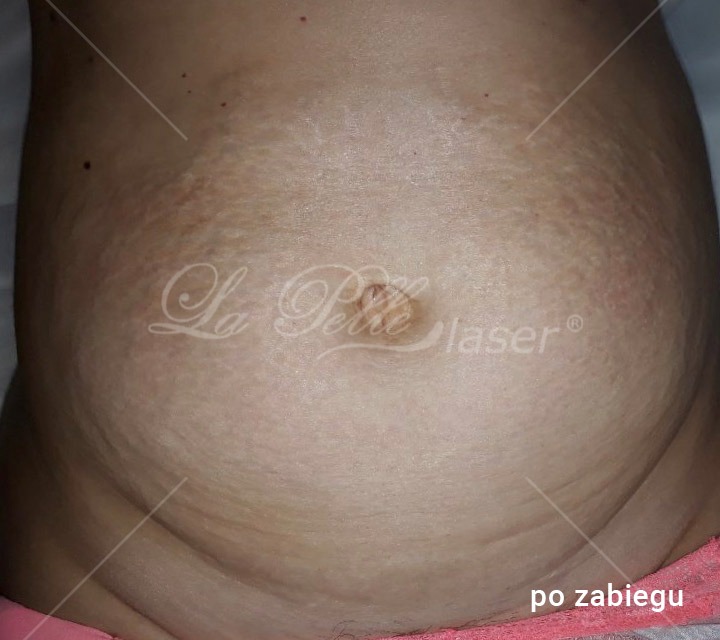 Redukcja wiotkiej skóry - Cutera Titan - Elżbieta Łukasik
